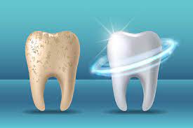 What are the Pros and Cons of Teeth Bleaching Treatment